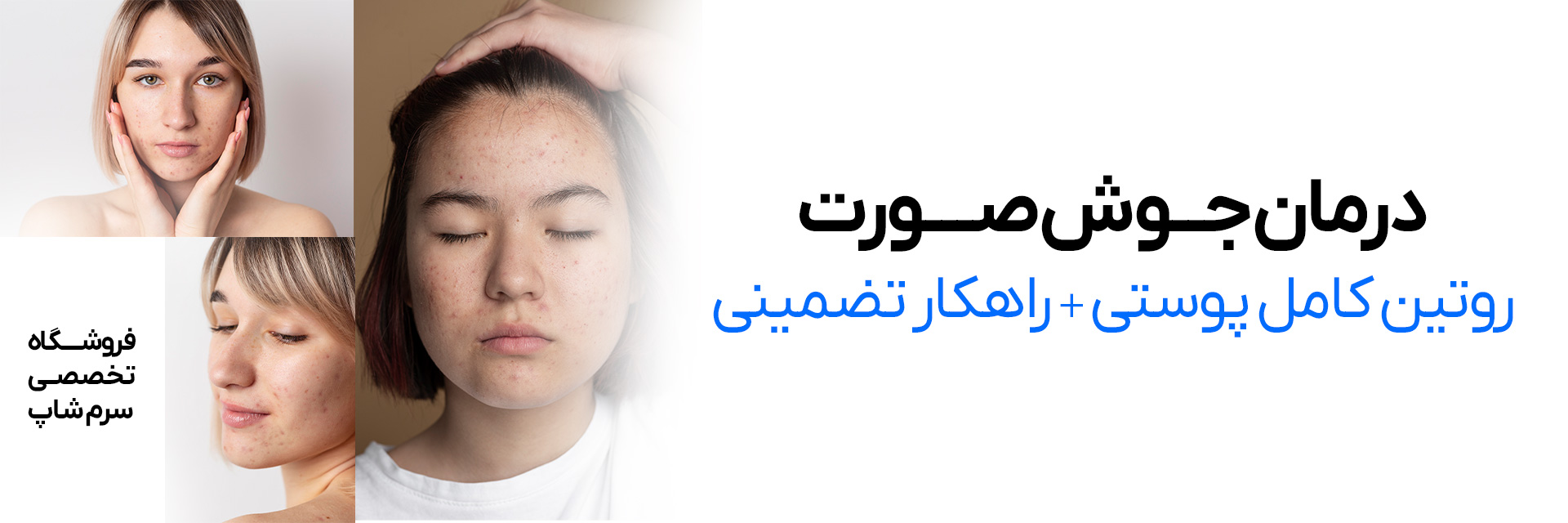 درمان جوش صورت + روتین و راهکار تضمینی